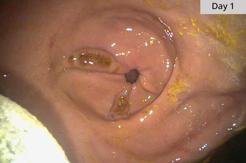 Glandular ulcers, day 1