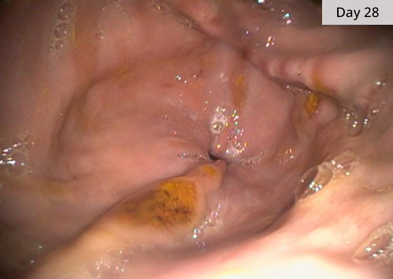 Glandular ulcers day 28